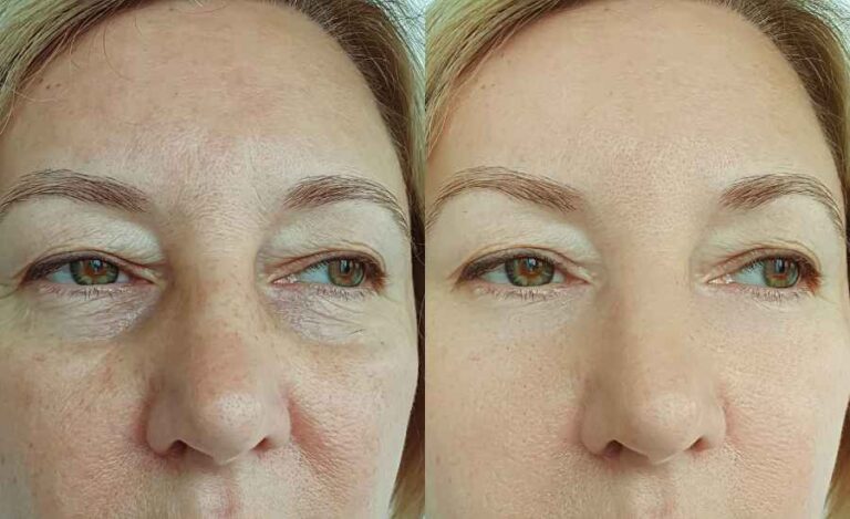 HIFU treatment before and after results