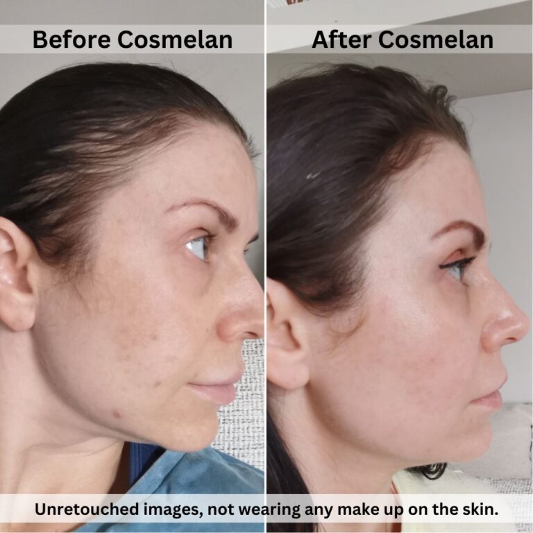 Cosmelan Peel before and after review