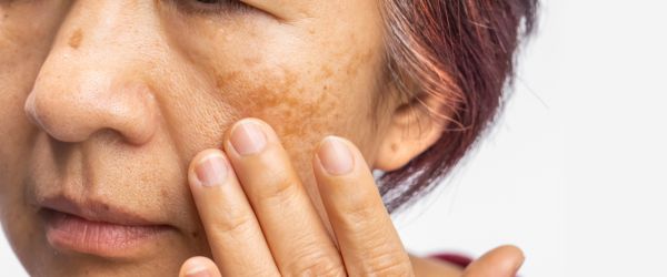 hyperpigmentation sun damage dark spots